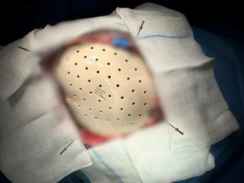 Implant czaszki z otworami, umieszczony w głowie pacjenta, otoczony materiałem chirurgicznym